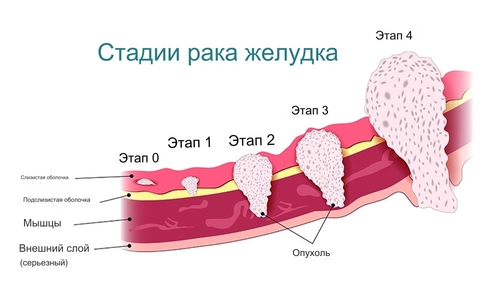 Стадии рака желудка