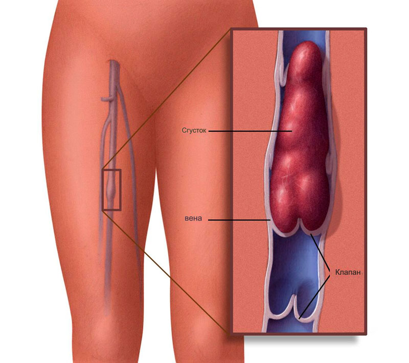 Тромбоз вен