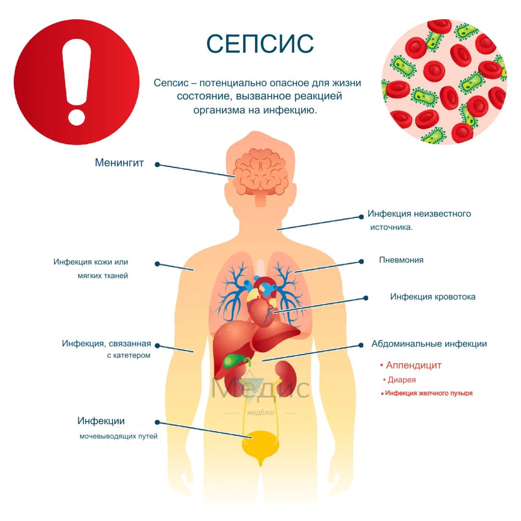 Когда врач обратит внимание на <b>сепсис</b>? 
