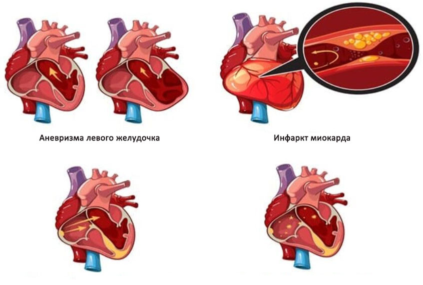 Сердечные заболевания