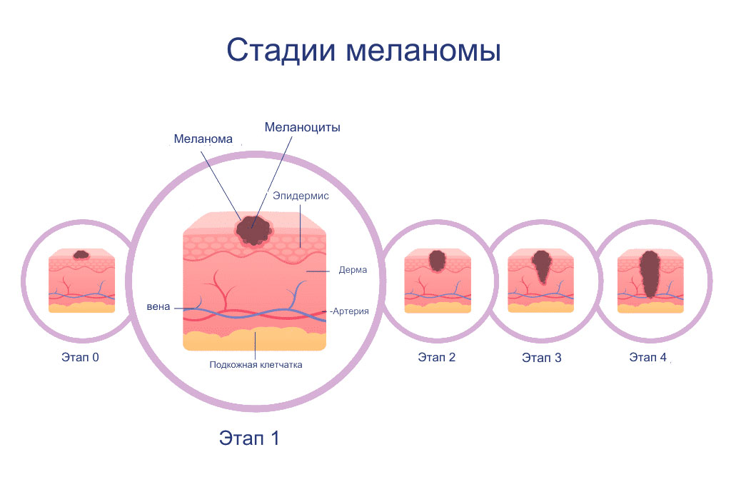 Стадии этапы меланомы