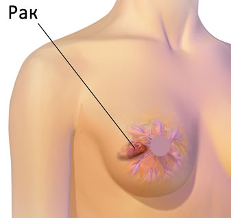 Рак груди