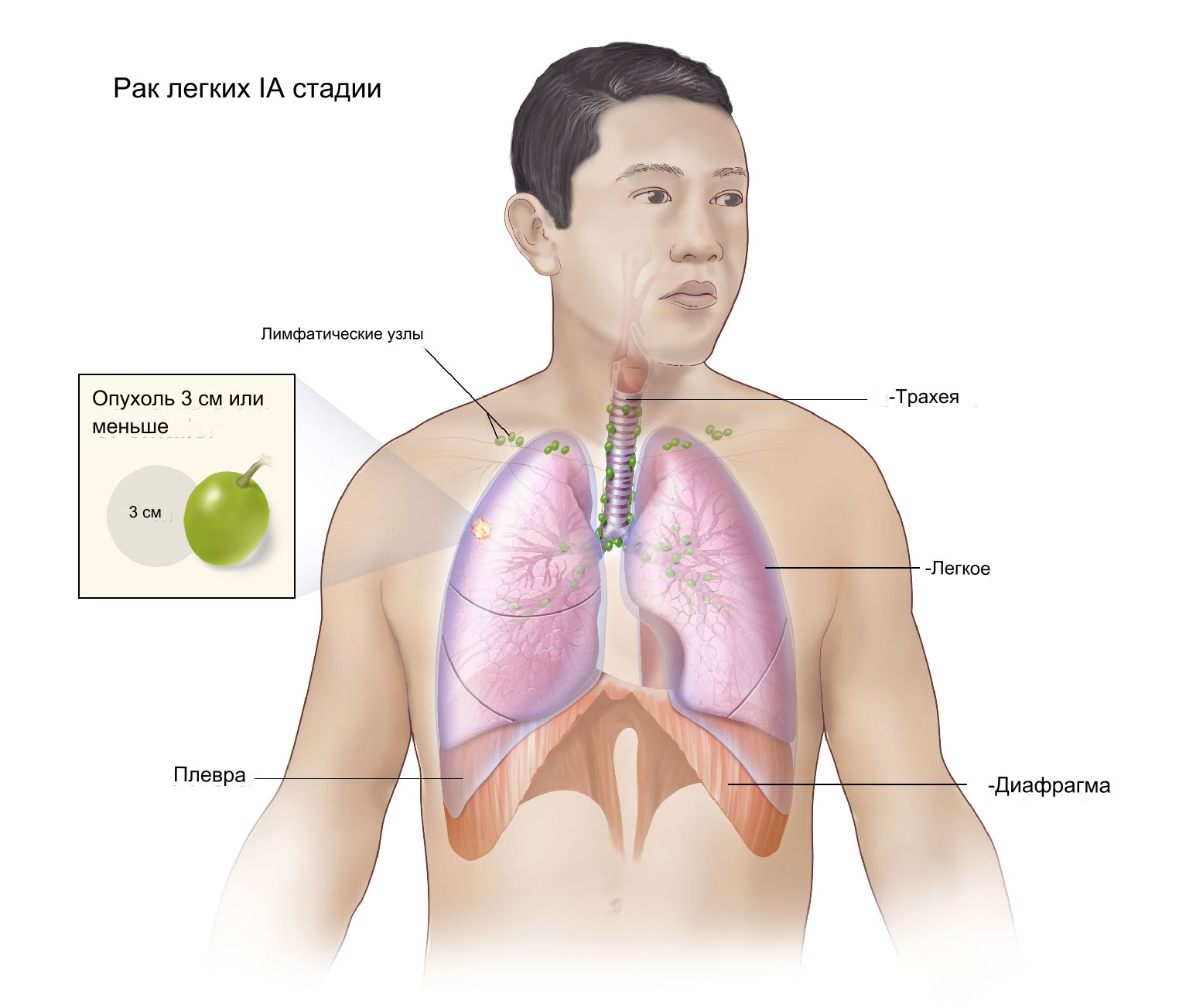 Рак лёгких 1а стадии