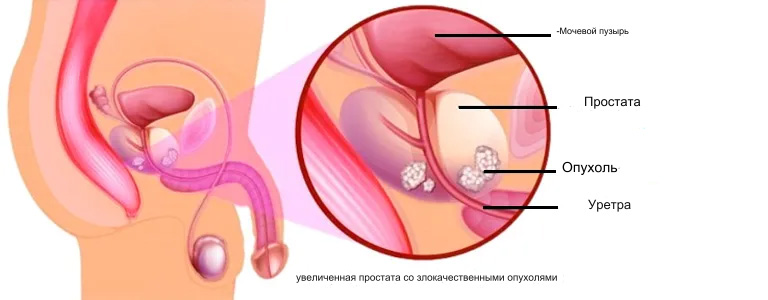 Схема рак простаты