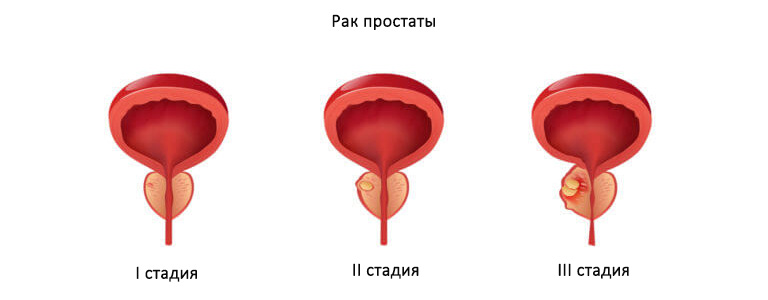 Стадии рака простаты