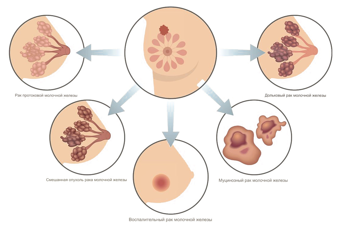 Типы рака груди