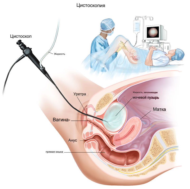 Цистоскопия мочевой пузырь