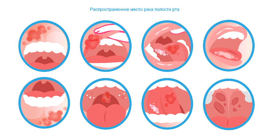 Где рак полости рта