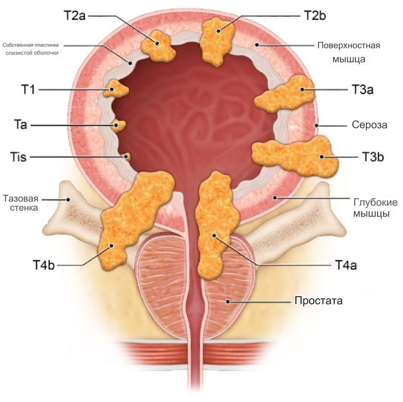 Рак мочевого пузыря лечение