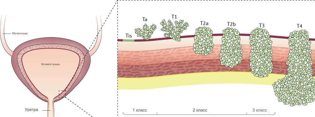 Рак мочевого пузыря стадии