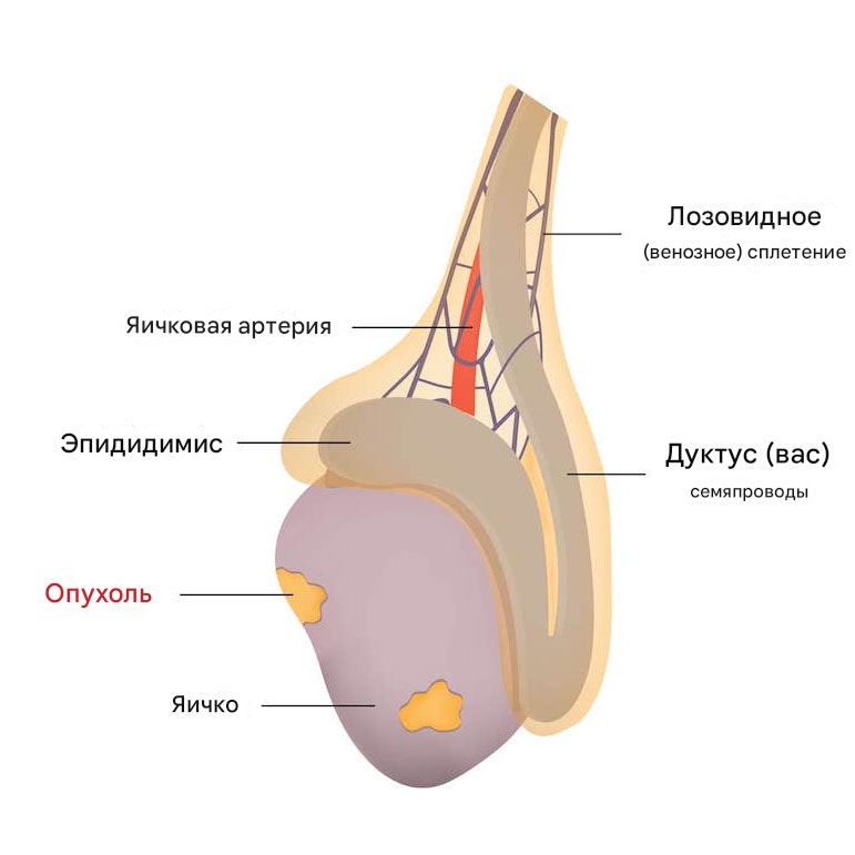 Рак яичка диагностика лечение