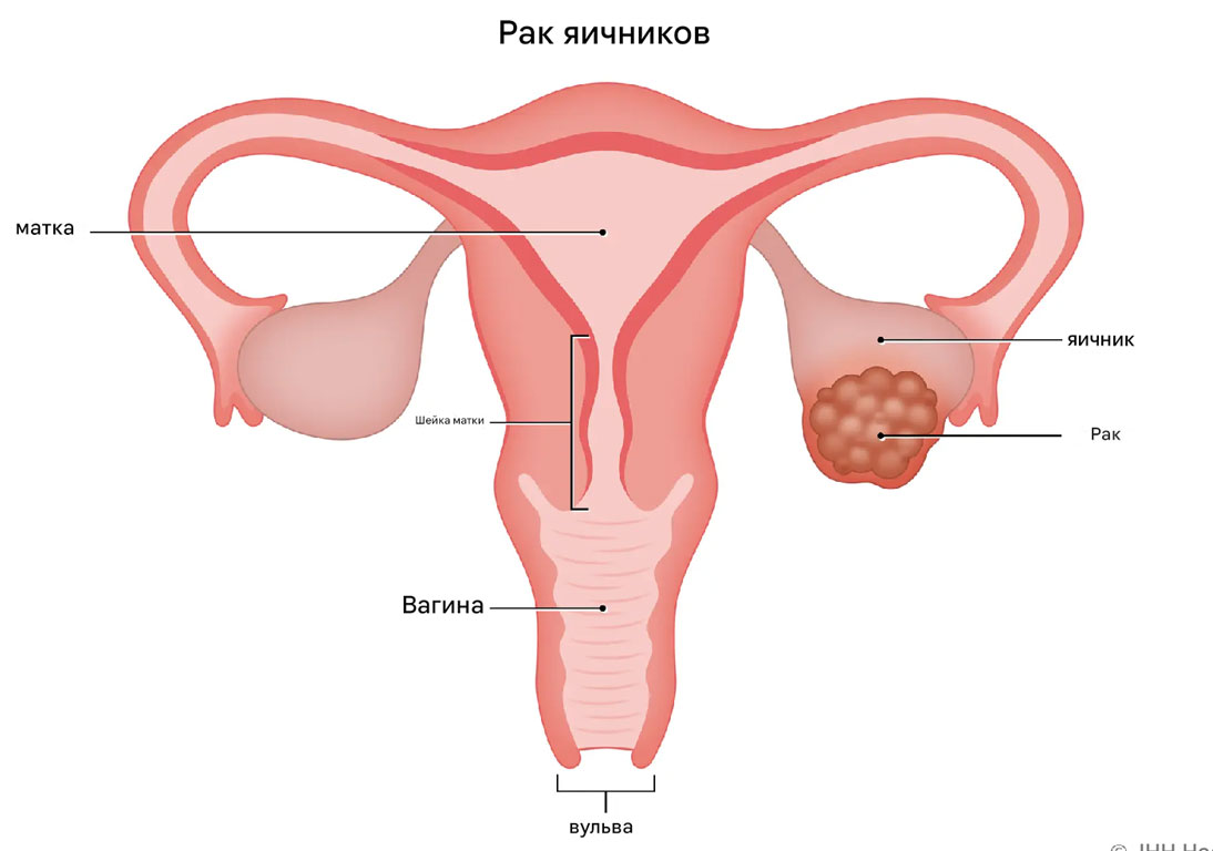 Рак яичников лечение