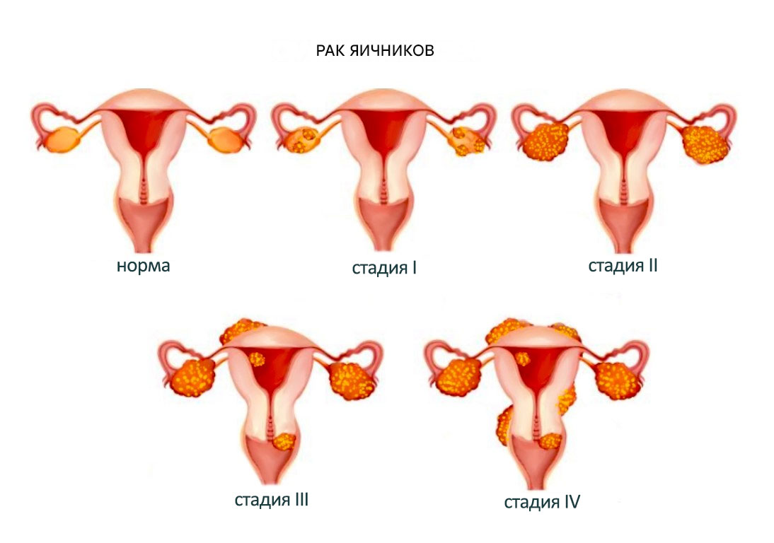 Рак яичников стадии