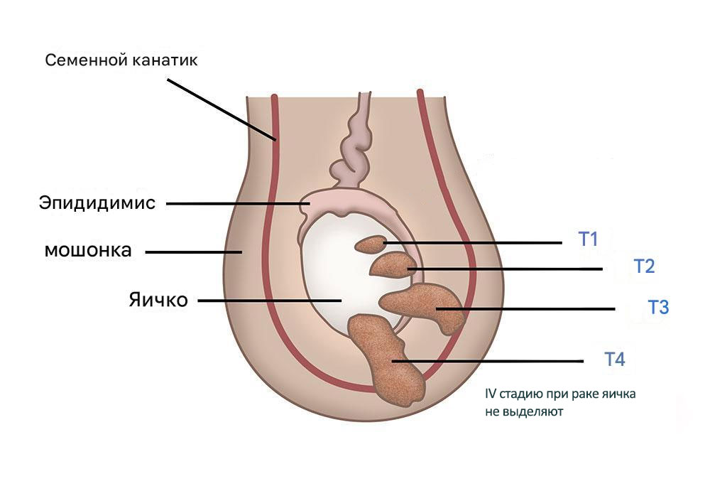 Стадии рака яичка лечение