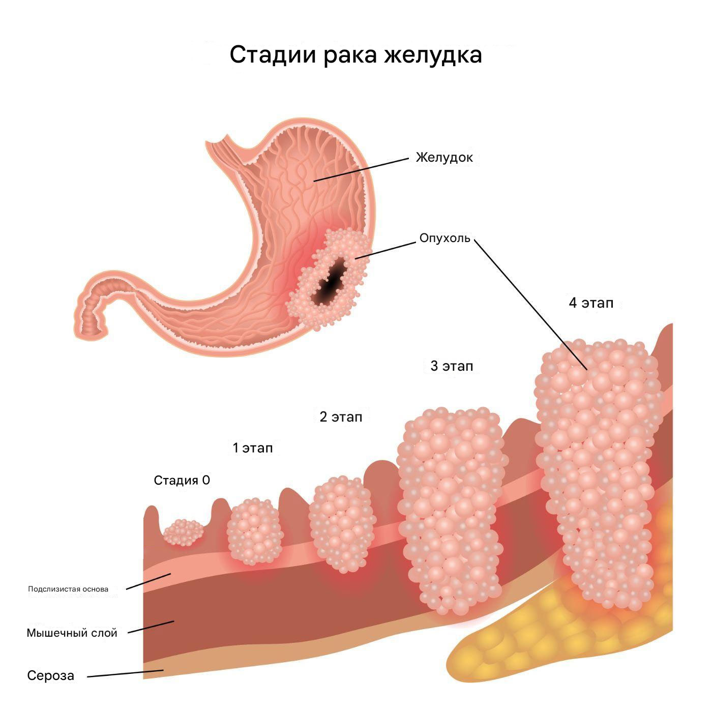 Стадии рака желудка